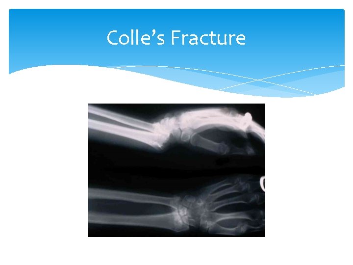 Colle’s Fracture 