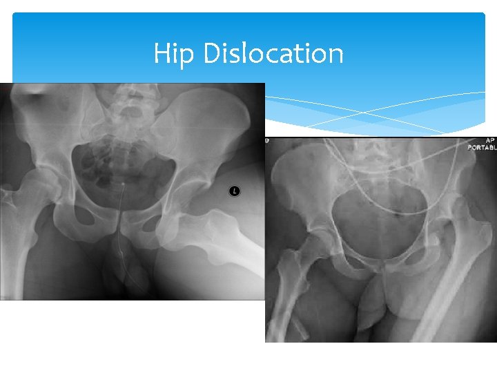 Hip Dislocation 