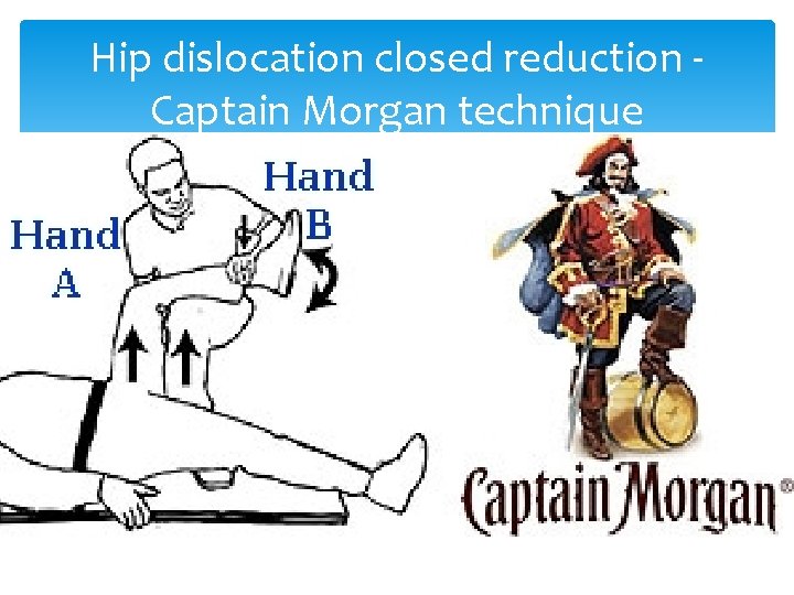Hip dislocation closed reduction - Captain Morgan technique 