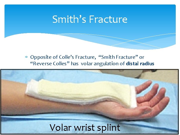 Smith’s Fracture Opposite of Colle’s Fracture, “Smith Fracture” or “Reverse Colles” has volar angulation