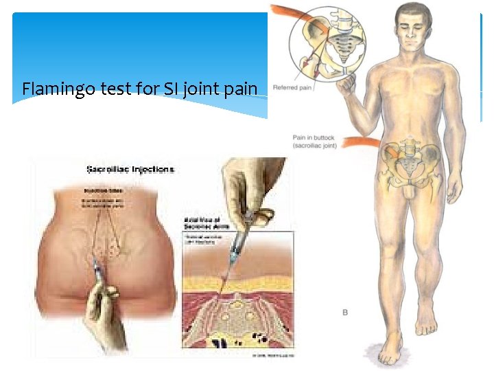 Flamingo test for SI joint pain 
