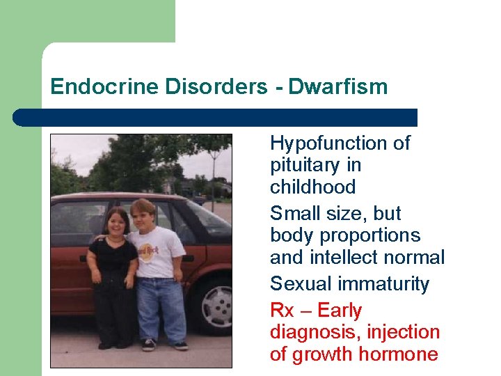 Endocrine Disorders - Dwarfism Hypofunction of pituitary in childhood Small size, but body proportions