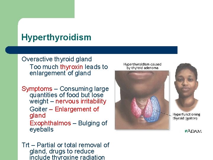 Hyperthyroidism Overactive thyroid gland Too much thyroxin leads to enlargement of gland Symptoms –