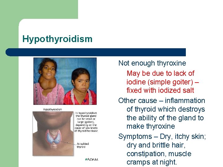 Hypothyroidism Not enough thyroxine May be due to lack of iodine (simple goiter) –