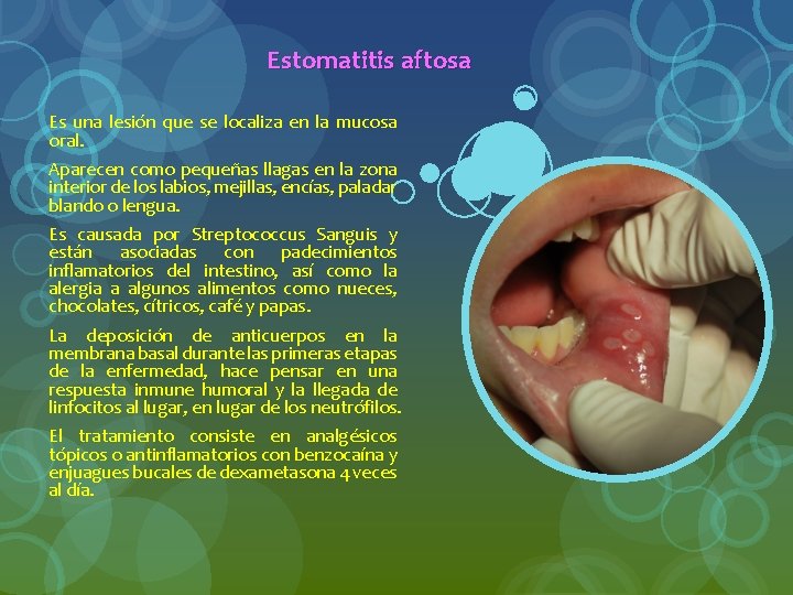 Estomatitis aftosa Es una lesión que se localiza en la mucosa oral. Aparecen como