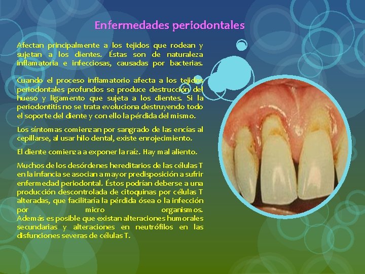 Enfermedades periodontales Afectan principalmente a los tejidos que rodean y sujetan a los dientes.