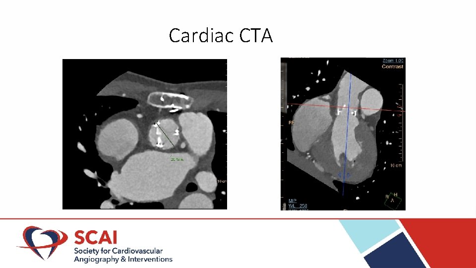 Cardiac CTA 