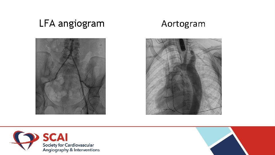 LFA angiogram Aortogram 