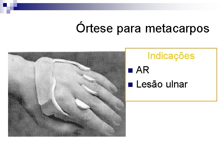 Órtese para metacarpos Indicações n AR n Lesão ulnar 