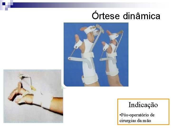 Órtese dinâmica Indicação • Pós-operatório de cirurgias da mão 