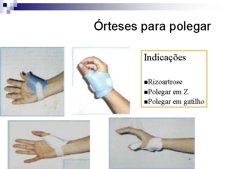 Órteses para polegar Indicações n. Rizoartrose n. Polegar em Z n. Polegar em gatilho