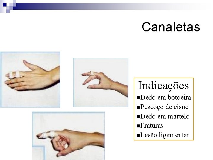Canaletas Indicações n. Dedo em botoeira n. Pescoço de cisne n. Dedo em martelo