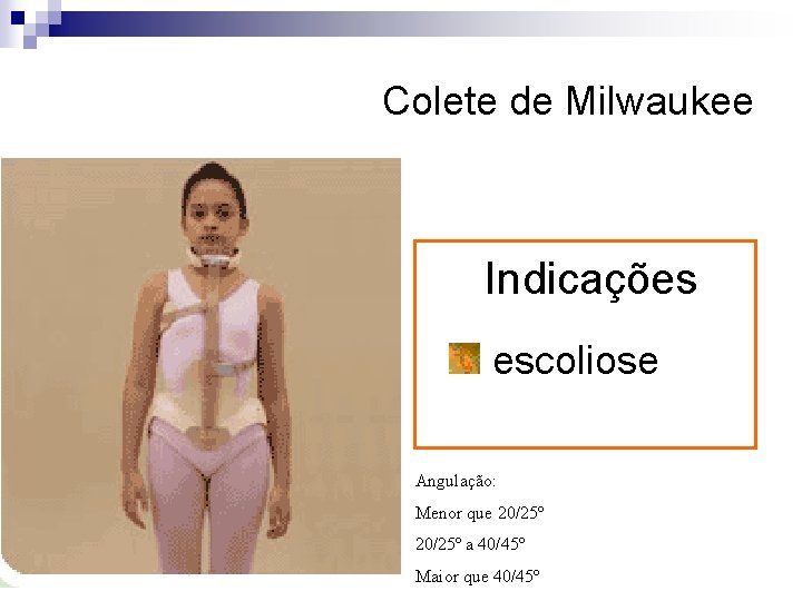 Colete de Milwaukee Indicações escoliose Angulação: Menor que 20/25º a 40/45º Maior que 40/45º