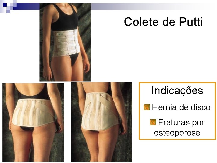 Colete de Putti Indicações Hernia de disco Fraturas por osteoporose 