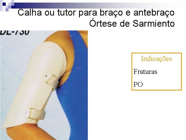 Calha ou tutor para braço e antebraço Órtese de Sarmiento Indicações Fraturas PO 