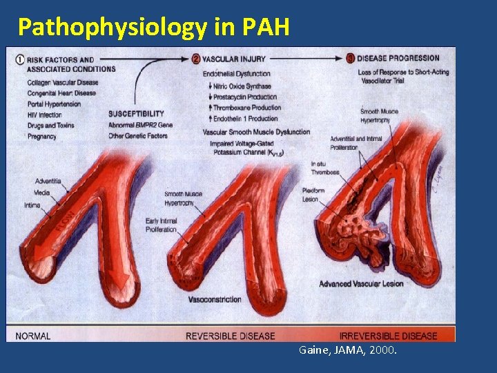 Pathophysiology in PAH Gaine, JAMA, 2000. 