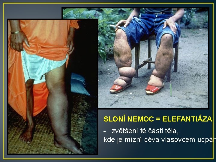 SLONÍ NEMOC = ELEFANTIÁZA - zvětšení té části těla, kde je mízní céva vlasovcem