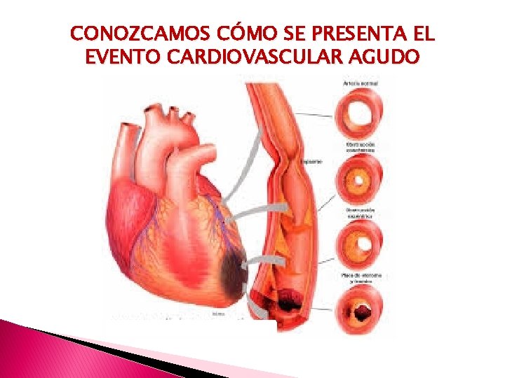 CONOZCAMOS CÓMO SE PRESENTA EL EVENTO CARDIOVASCULAR AGUDO 