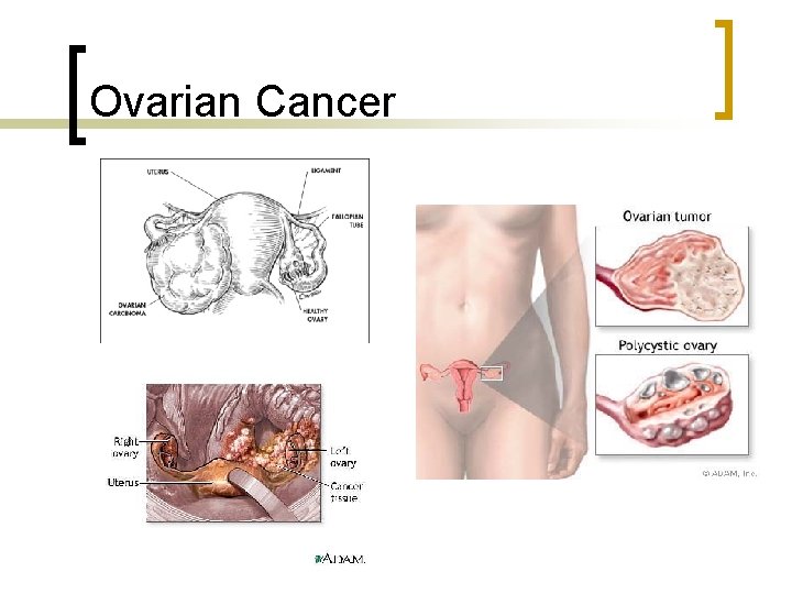 Ovarian Cancer 