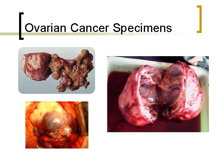 Ovarian Cancer Specimens 