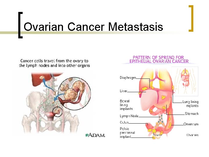 Ovarian Cancer Metastasis 