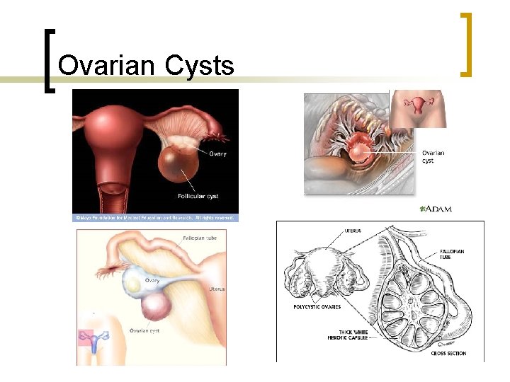 Ovarian Cysts 