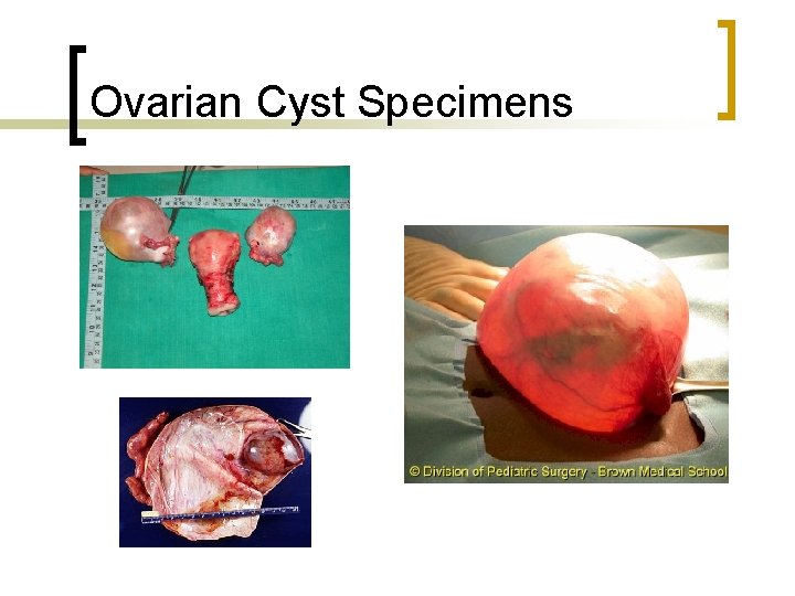 Ovarian Cyst Specimens 