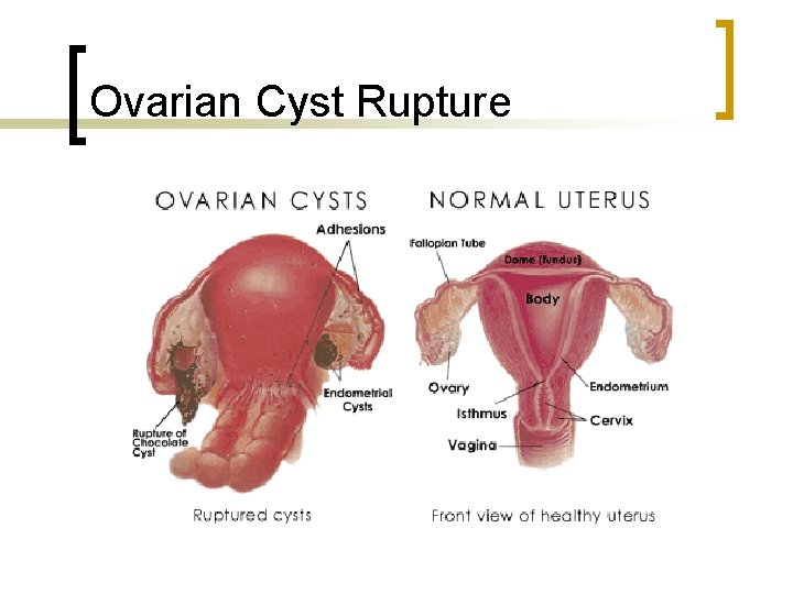 Ovarian Cyst Rupture 