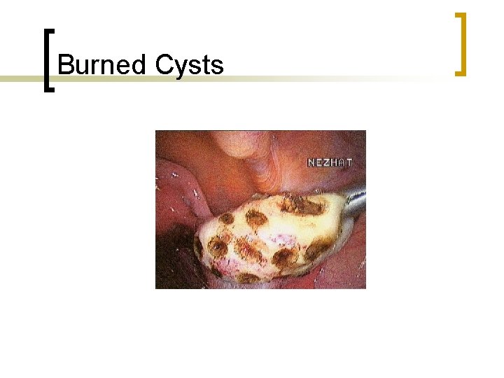 Burned Cysts 