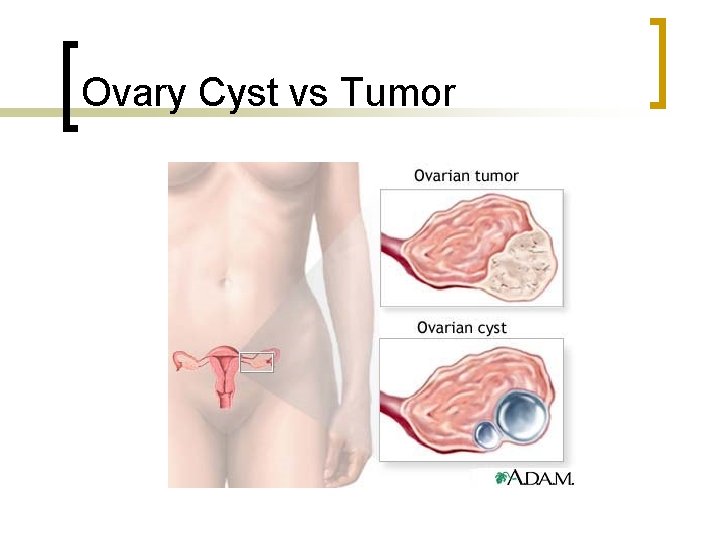 Ovary Cyst vs Tumor 