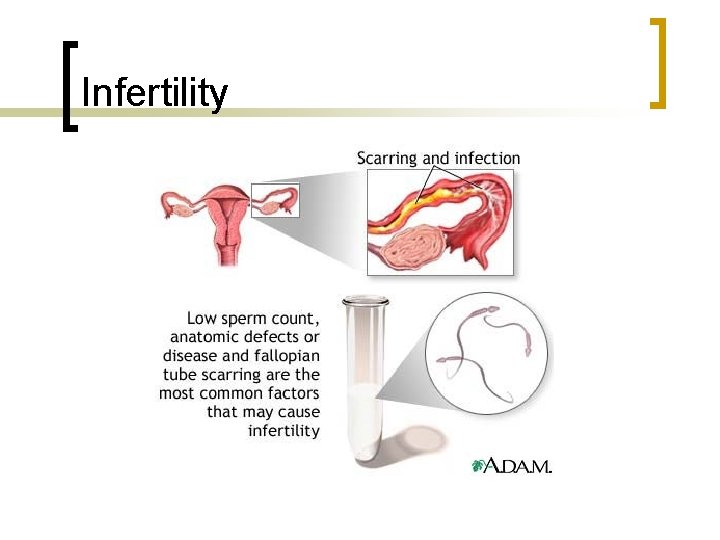 Infertility 