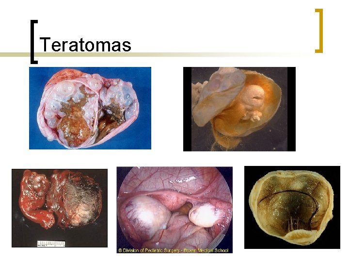 Teratomas 