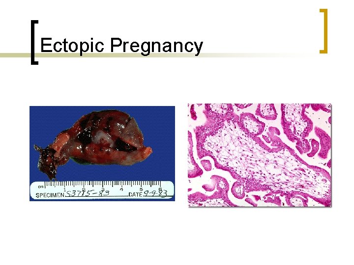 Ectopic Pregnancy 