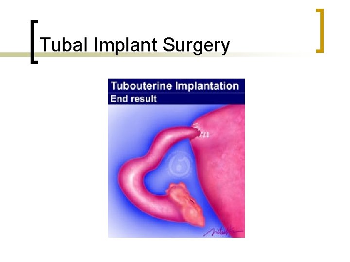 Tubal Implant Surgery 