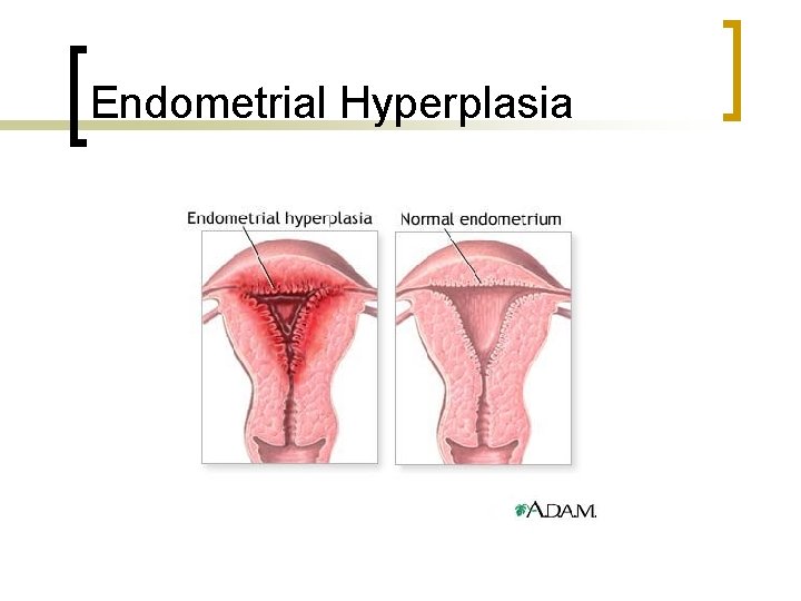 Endometrial Hyperplasia 