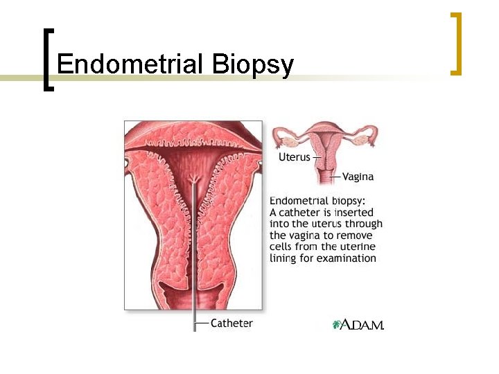 Endometrial Biopsy 