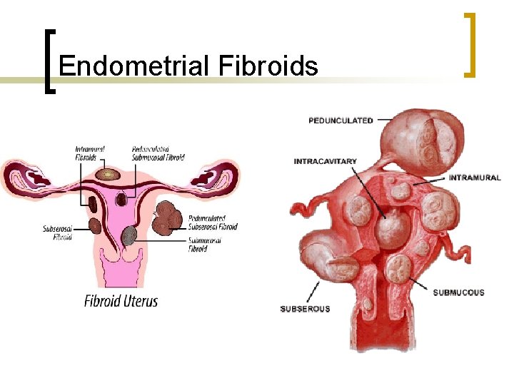 Endometrial Fibroids 