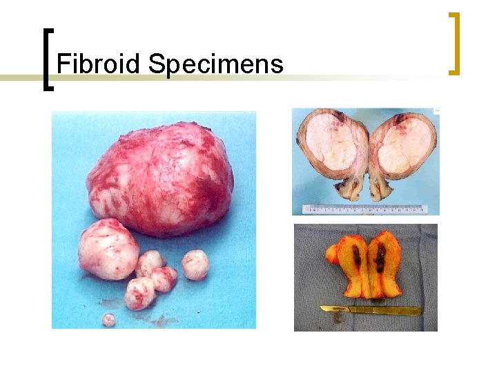 Fibroid Specimens 