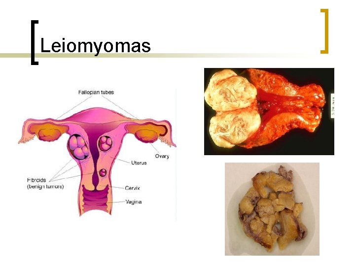 Leiomyomas 