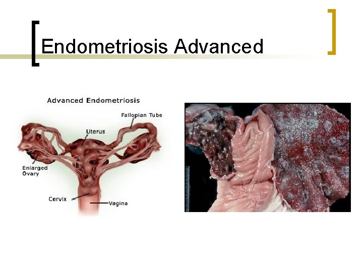 Endometriosis Advanced 