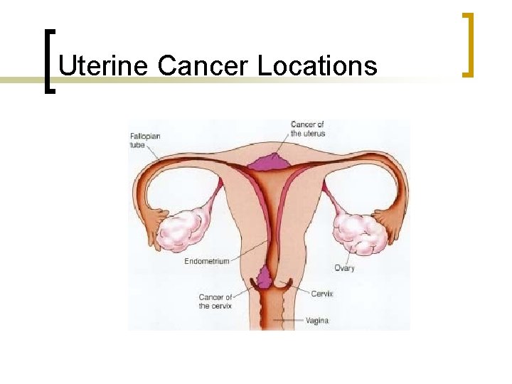 Uterine Cancer Locations 