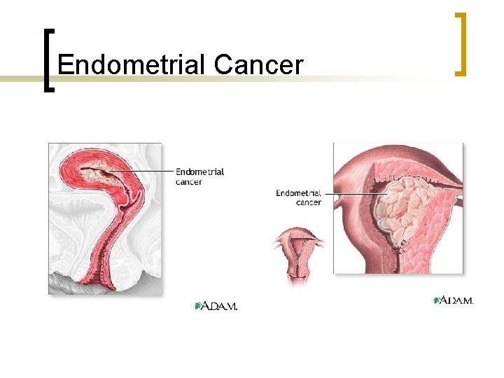 Endometrial Cancer 