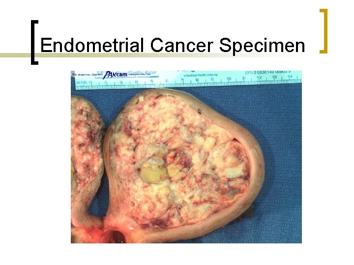 Endometrial Cancer Specimen 