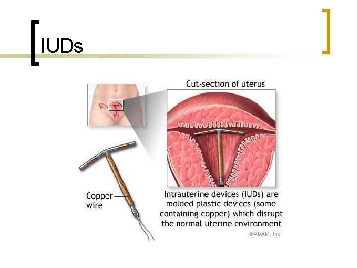 IUDs 