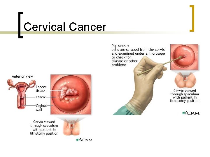 Cervical Cancer 