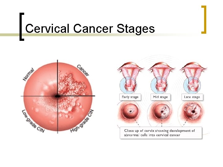 Cervical Cancer Stages 