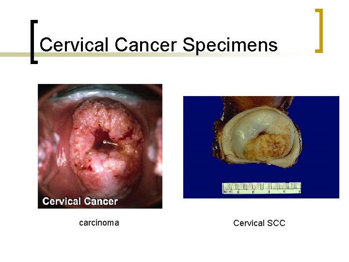 Cervical Cancer Specimens carcinoma Cervical SCC 