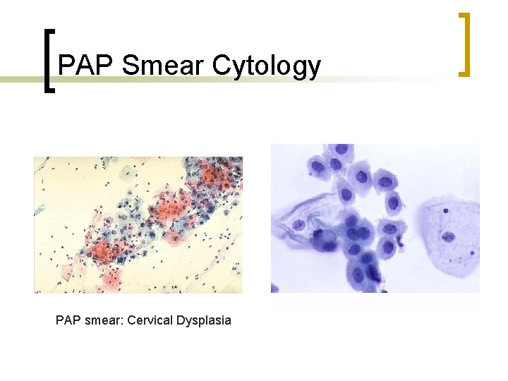 PAP Smear Cytology PAP smear: Cervical Dysplasia 