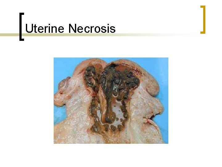 Uterine Necrosis 