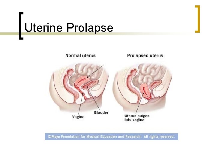 Uterine Prolapse 
